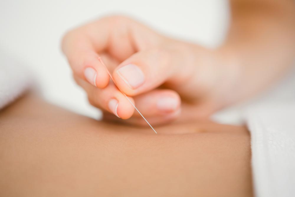 Woman Holding An Acupuncture Needle